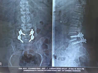 Spinal Surgery for Sp'listhesis Spinal Fixation