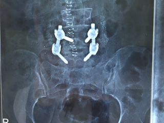 Spinal Surgery for Sp'listhesis Spinal Fixation