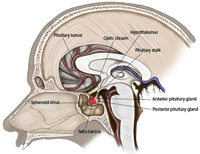 Dr Partha Pratim Bishnu India Kolkata Brain Tumors Metastatic Brain Tumors Primary Brain Tumors Awake Surgery Bhubaneswar Cuttack Siliguri Tripura Agartala Mizoram Assam Guwahati Arunachal Pradesh Meghalaya Shillong Darjeeling